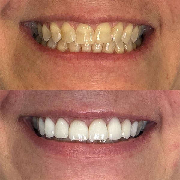 before-and-after-veneers