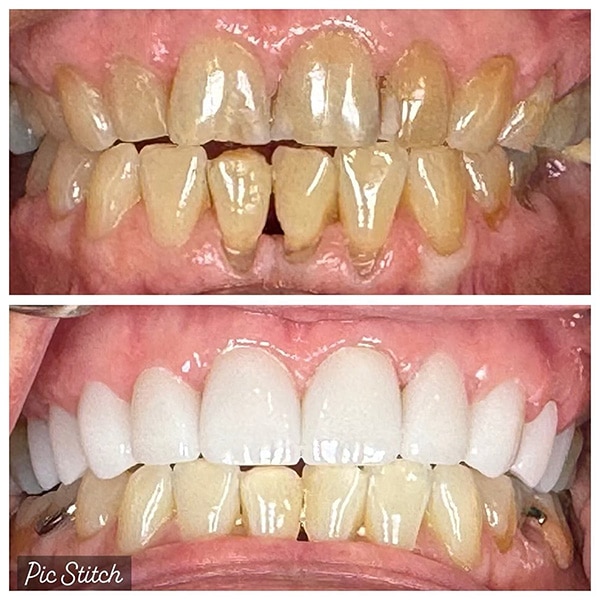 smile restoration