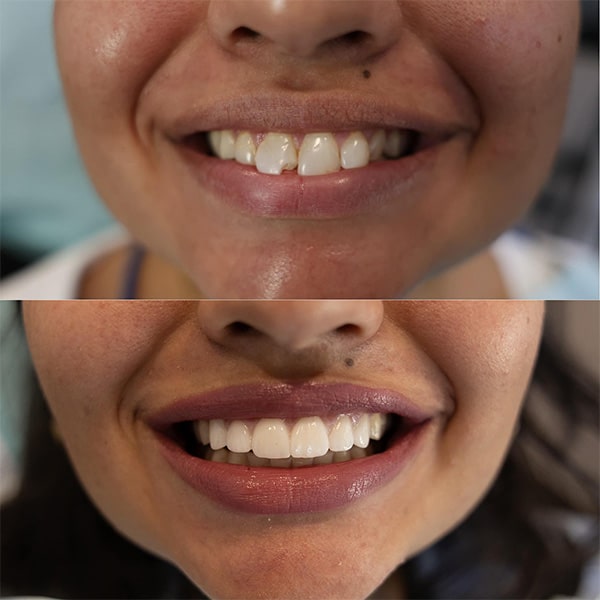 smile transformation